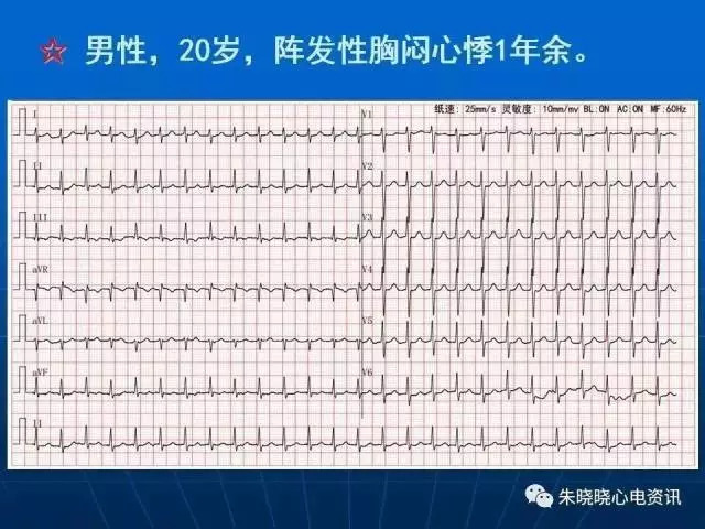 心电图判读