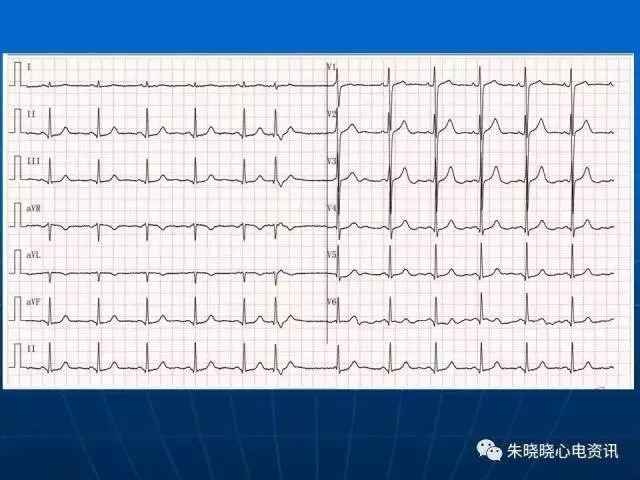 心电图判读