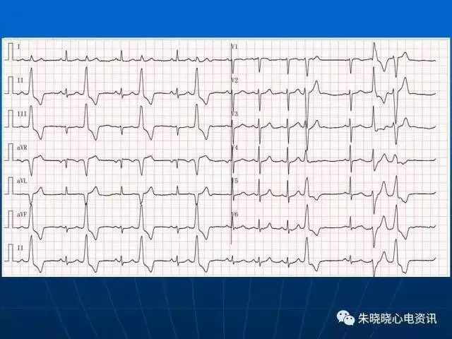 心电图判读
