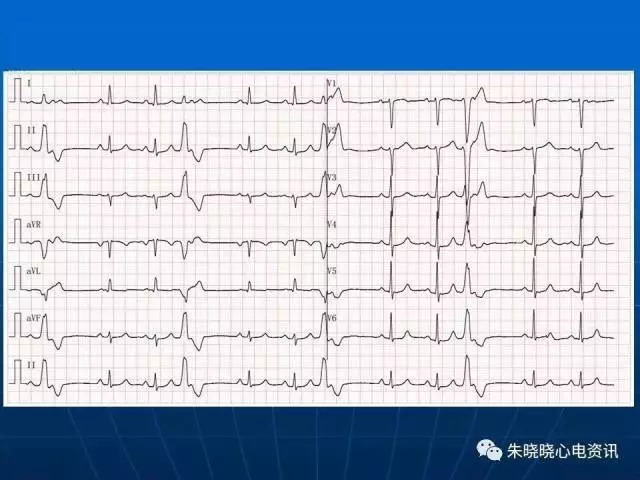心电图判读