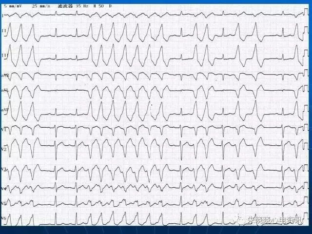 心电图判读