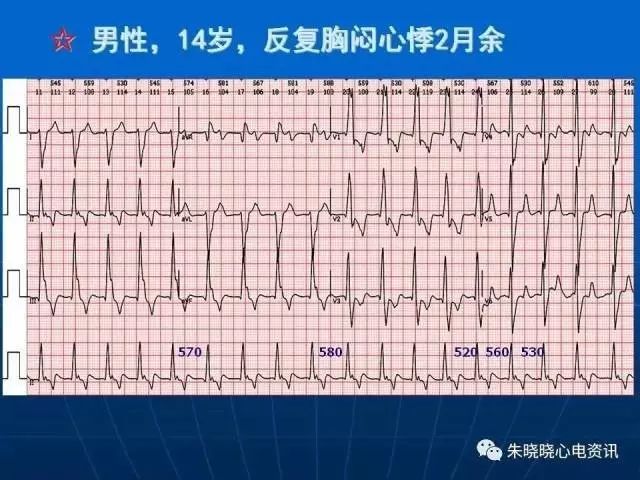 心电图判读