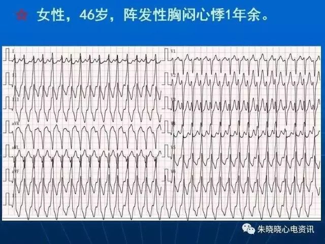 心电图判读