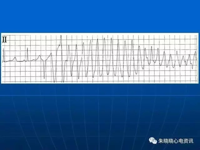 心电图判读