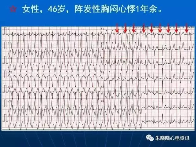 心电图判读