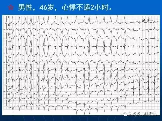 心电图判读