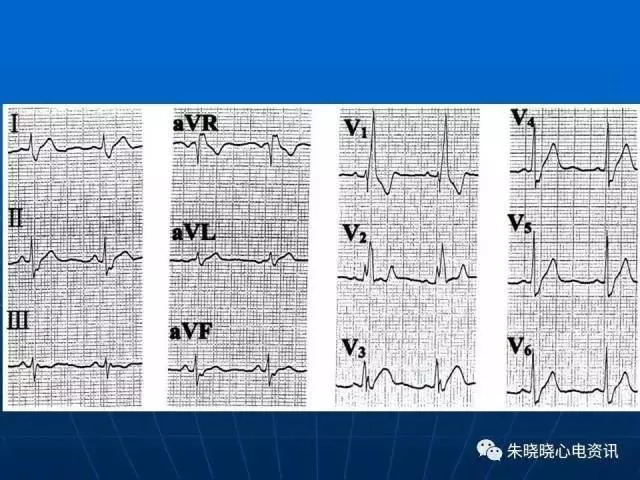 心电图判读