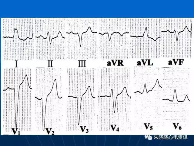 心电图判读
