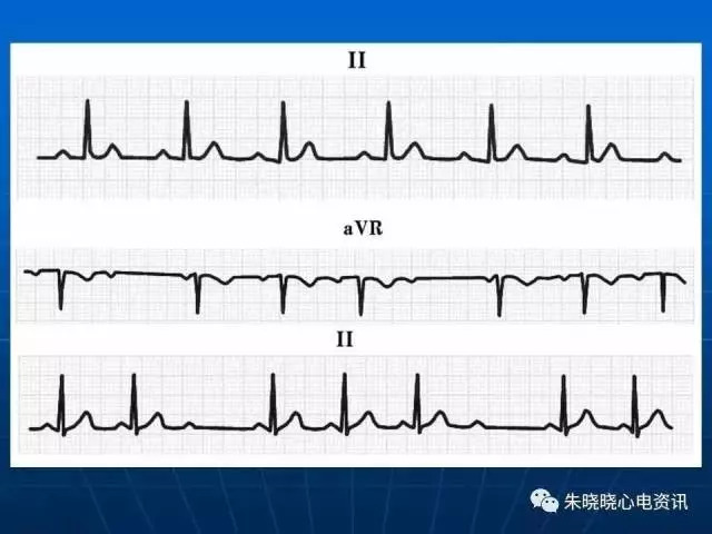 心电图判读