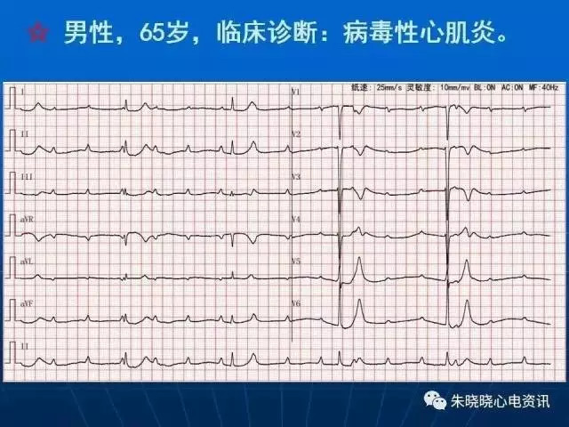 心电图判读