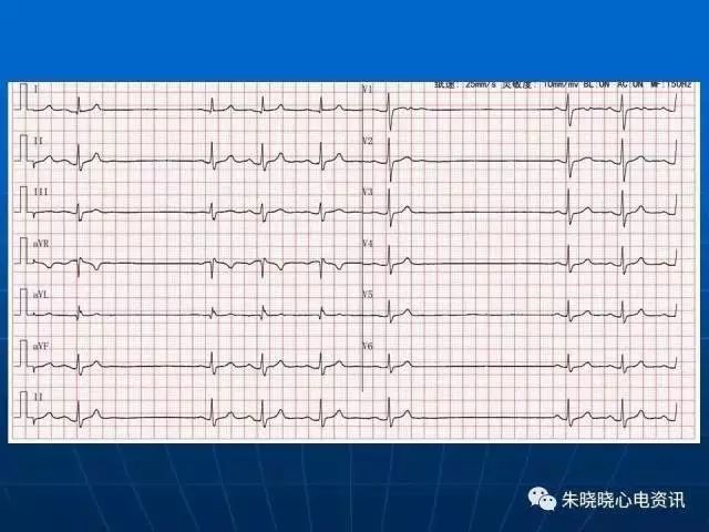 心电图判读
