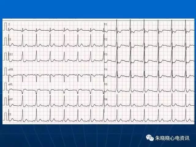 心电图判读