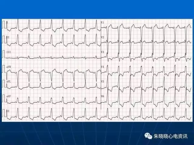 心电图判读