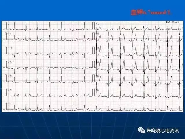 心电图判读