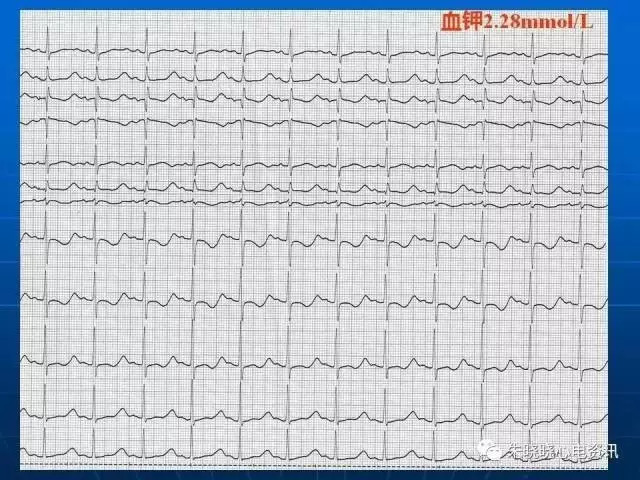 心电图判读