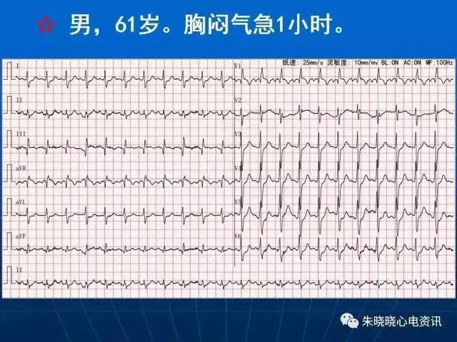 心电图判读