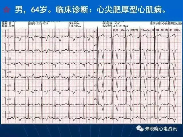 心电图判读