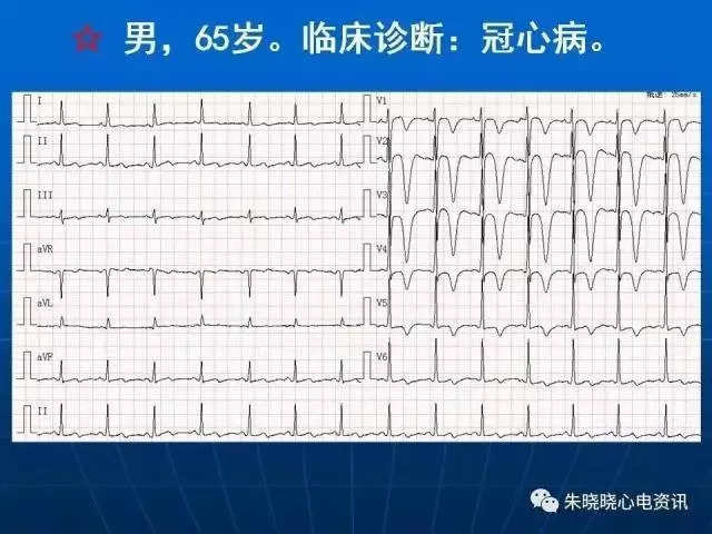 心电图判读