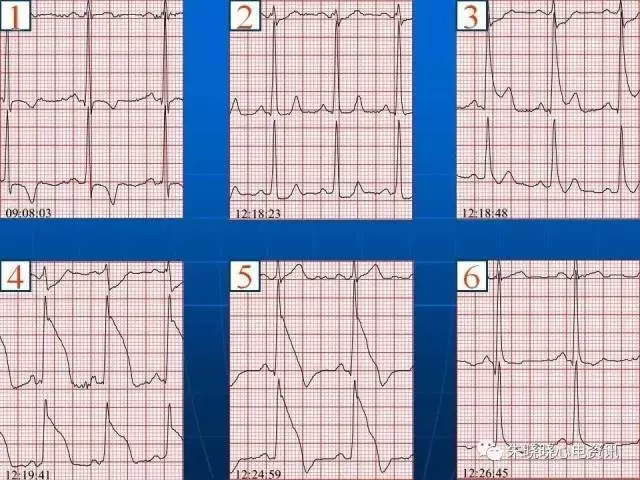 心电图判读