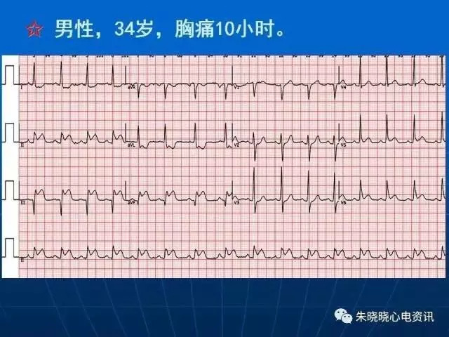 心电图判读