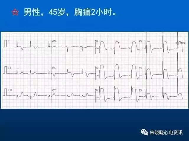 心电图判读