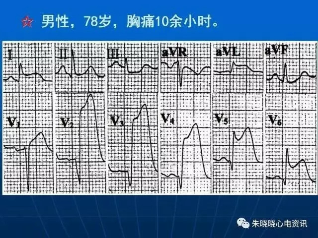 心电图判读