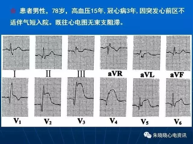 心电图判读