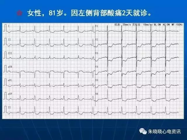 心电图判读