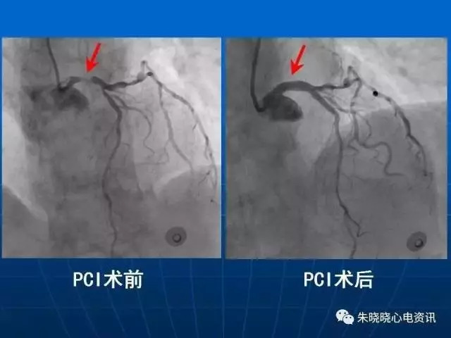 心电图判读