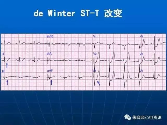 心电图判读