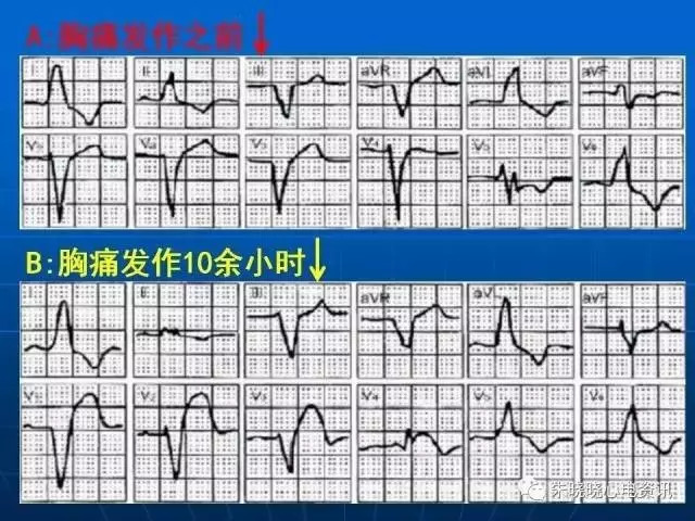 心电图判读