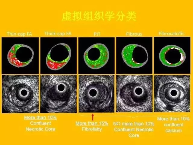 不同冠脉介入影像技术的临床应用与选择