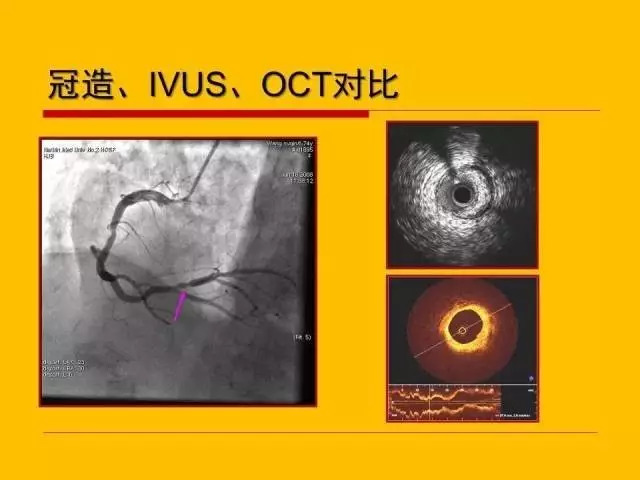 不同冠脉介入影像技术的临床应用与选择