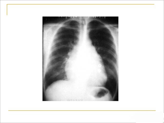 【课件】先天性心脏病影像学诊断