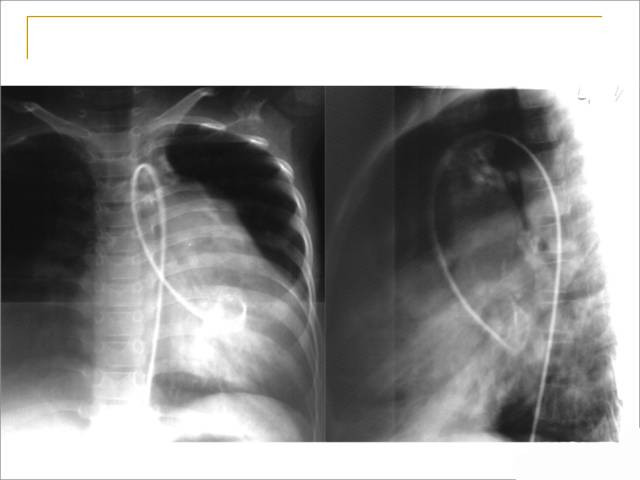 【课件】先天性心脏病影像学诊断