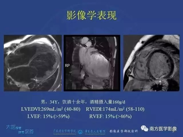 酒精性心脏病临床表现与诊治