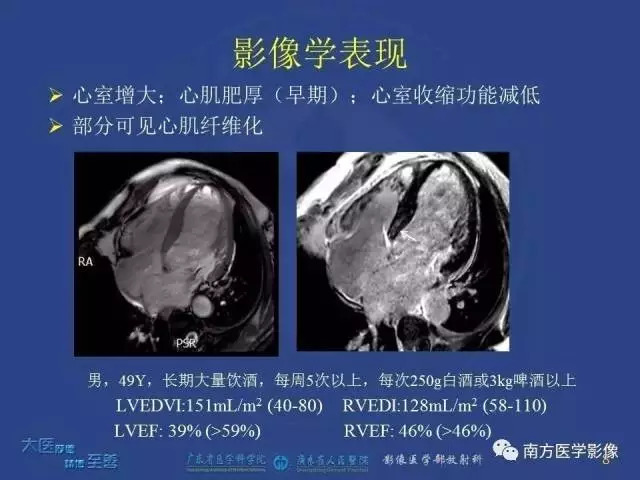 酒精性心脏病临床表现与诊治