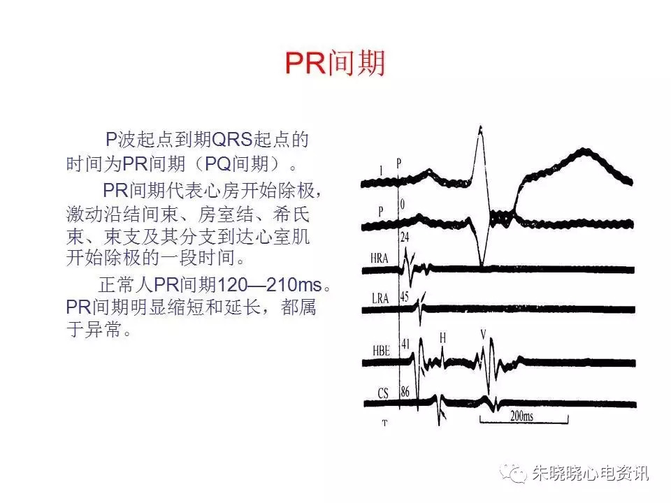 心电图危急值最全总结，赶快收藏备用！