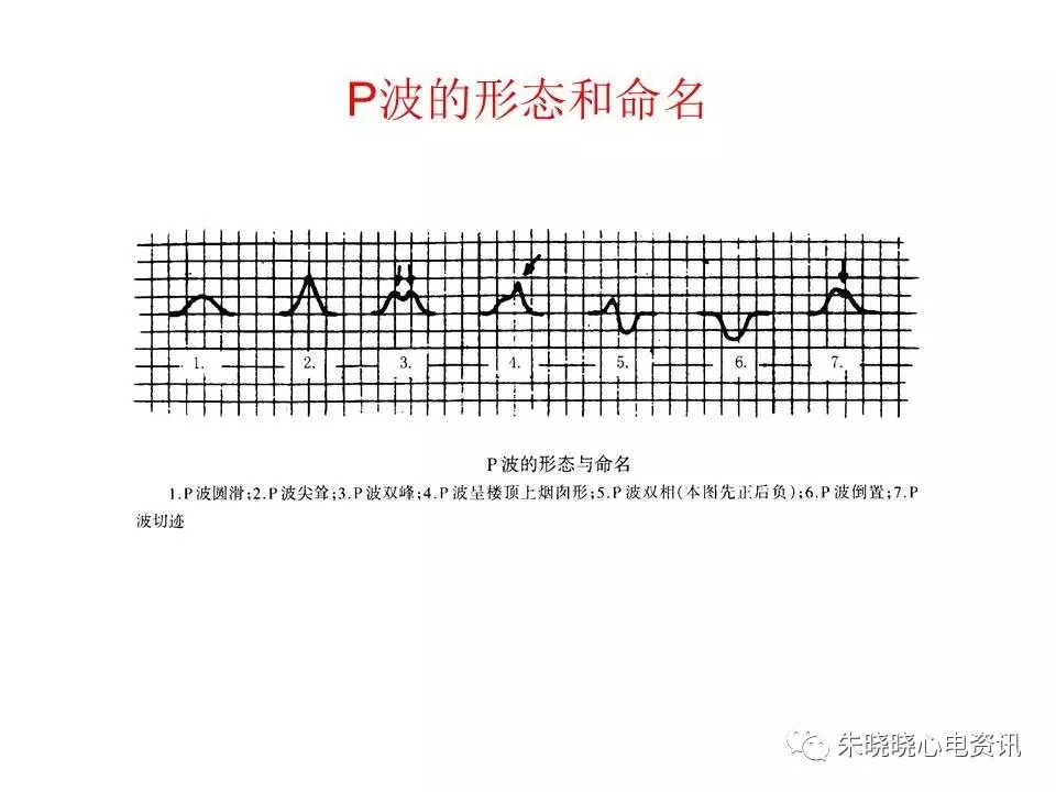 心电图危急值最全总结，赶快收藏备用！