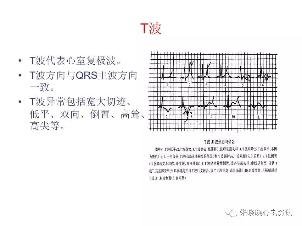 心电图危急值最全总结，赶快收藏备用！