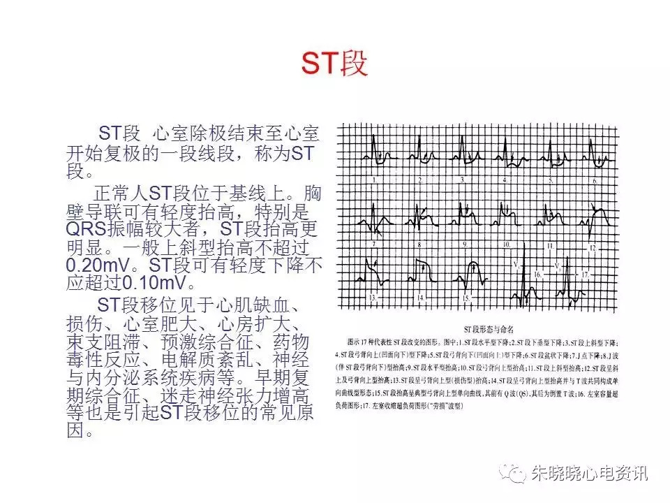 心电图危急值最全总结，赶快收藏备用！