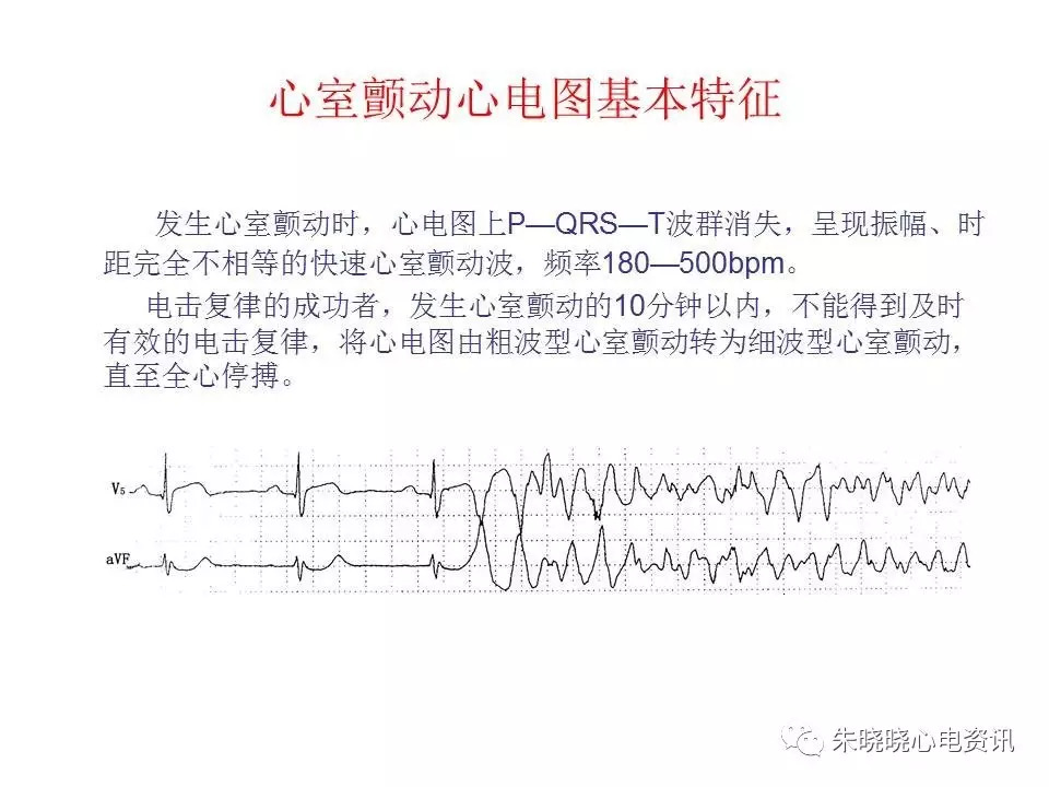 心电图危急值最全总结，赶快收藏备用！