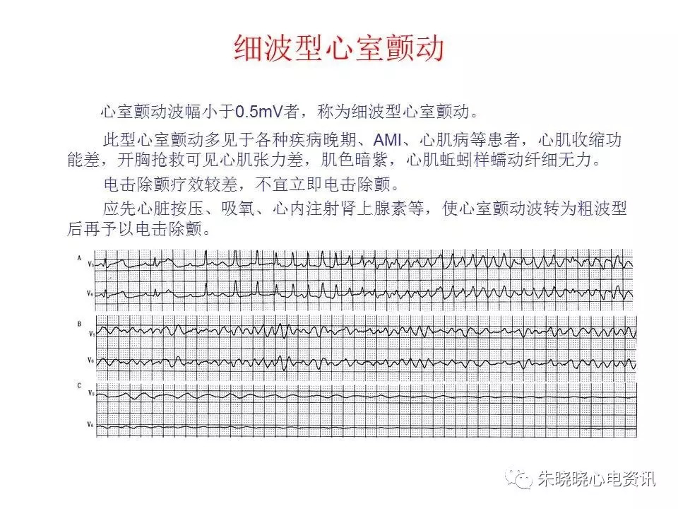 心电图危急值最全总结，赶快收藏备用！