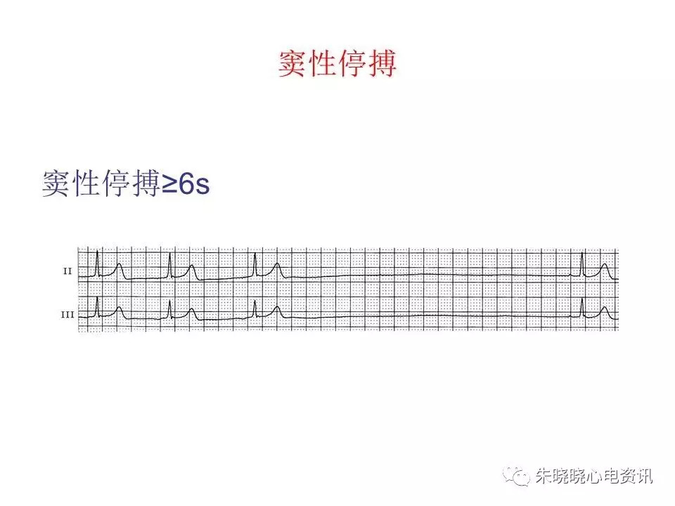 心电图危急值最全总结，赶快收藏备用！