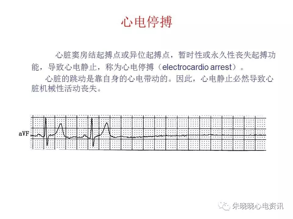 心电图危急值最全总结，赶快收藏备用！