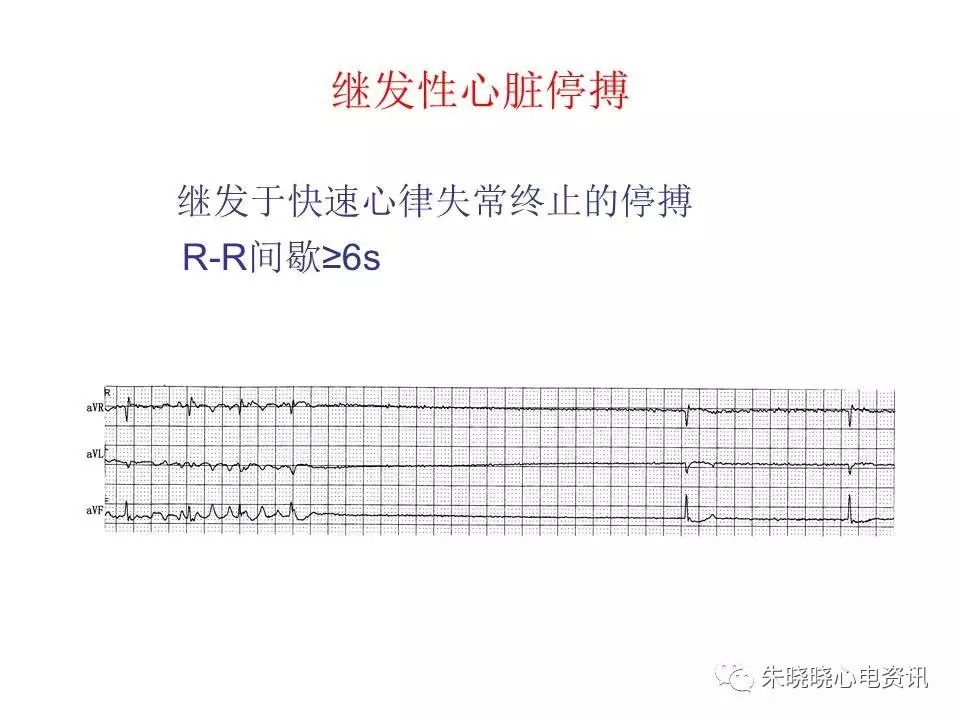 心电图危急值最全总结，赶快收藏备用！