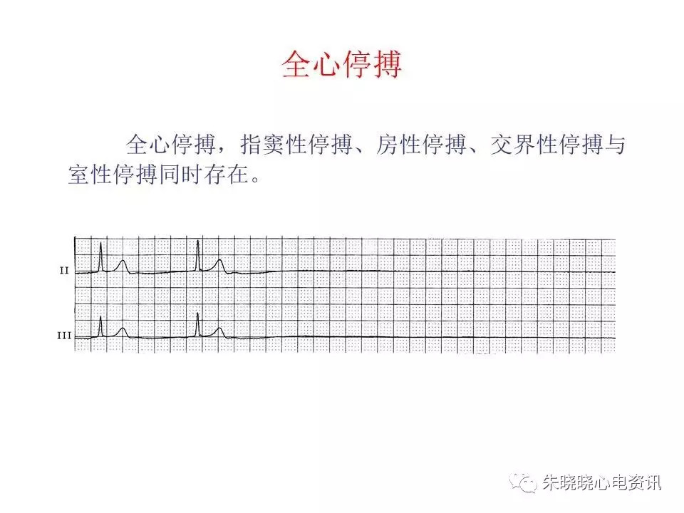 心电图危急值最全总结，赶快收藏备用！