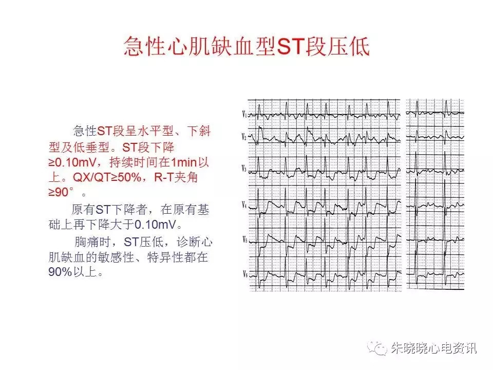 心电图危急值最全总结，赶快收藏备用！