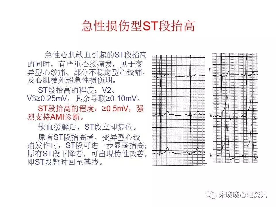 心电图危急值最全总结，赶快收藏备用！