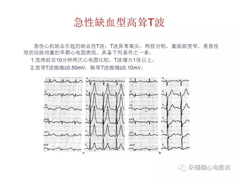 心电图危急值最全总结，赶快收藏备用！